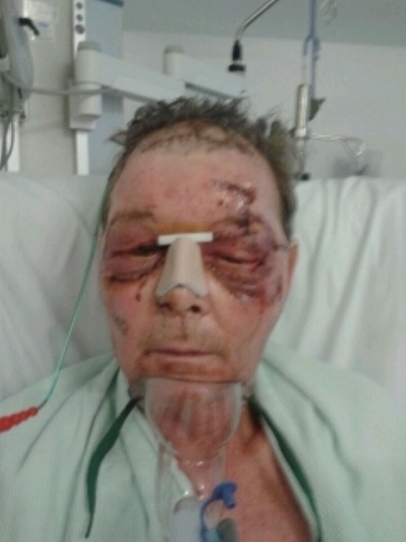 Employee needs facial reconstruction after machinery accident, the safety guard had been removed.